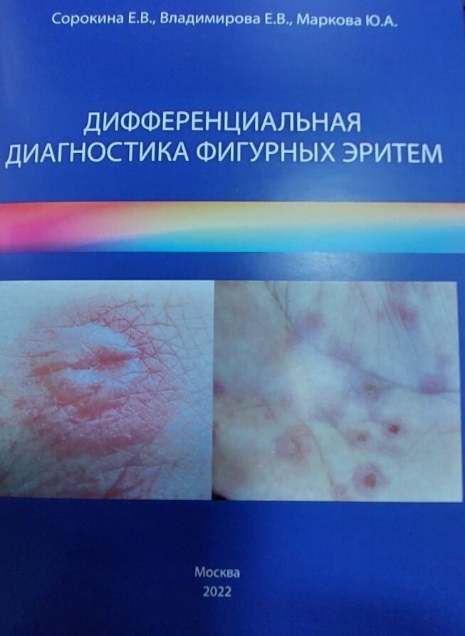 Дифференциальная диагностика фигурных эритем Пособие для вроачей авторов Сорокиной Е.В., Владимировой Е.В., Марковой Ю.А